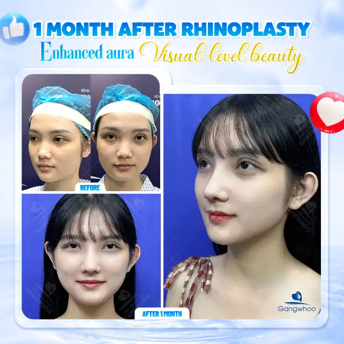 What Is Ultra V Lift Thread Nose Lift? Advantages and Disadvantages of the Method