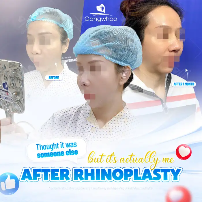 What Is Ultra V Lift Thread Nose Lift? Advantages and Disadvantages of the Method