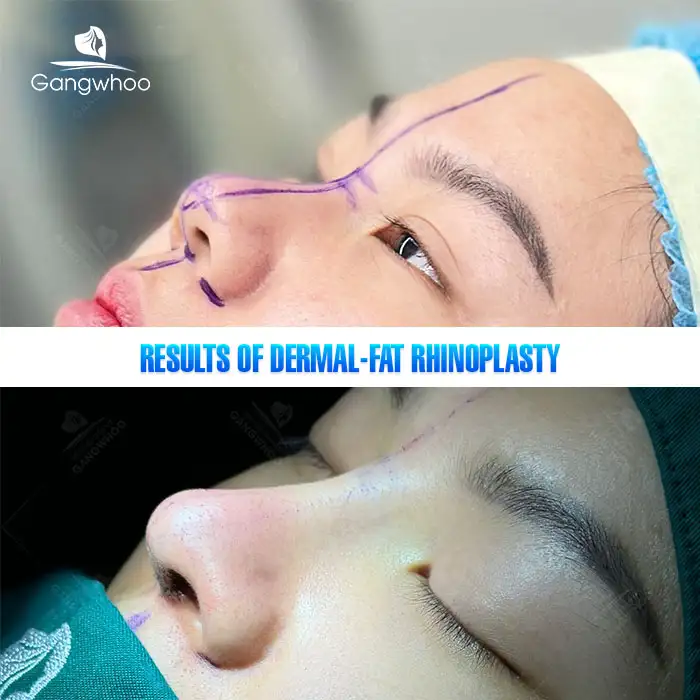 What is dermal fat graft rhinoplasty? What are the advantages and disadvantages of this method? 3 What is dermal fat graft rhinoplasty? What are the advantages and disadvantages of this method?