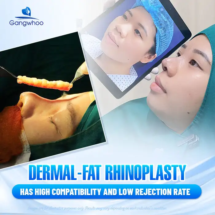 What is dermal fat graft rhinoplasty? What are the advantages and disadvantages of this method? 1 What is dermal fat graft rhinoplasty? What are the advantages and disadvantages of this method?
