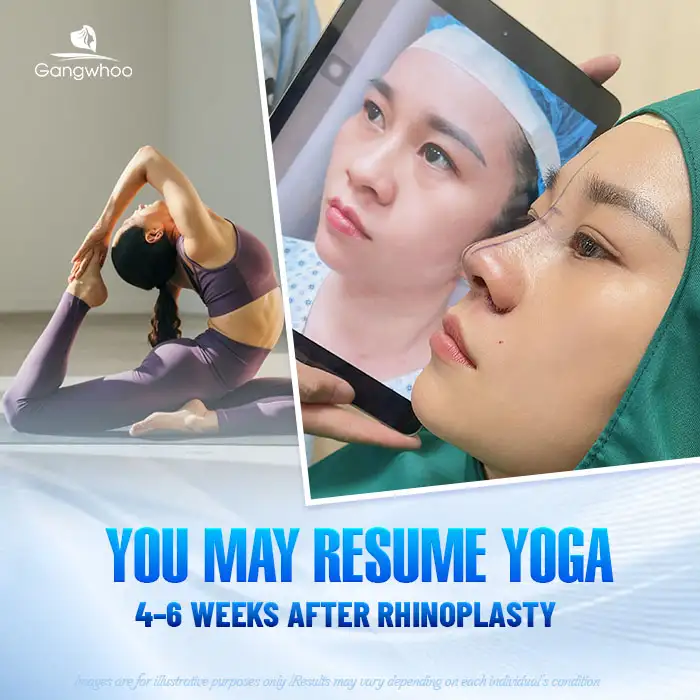 How long after rhinoplasty can you practice yoga? Important notes when practicing yoga 1 How long after rhinoplasty can you practice yoga? Important notes when practicing yoga