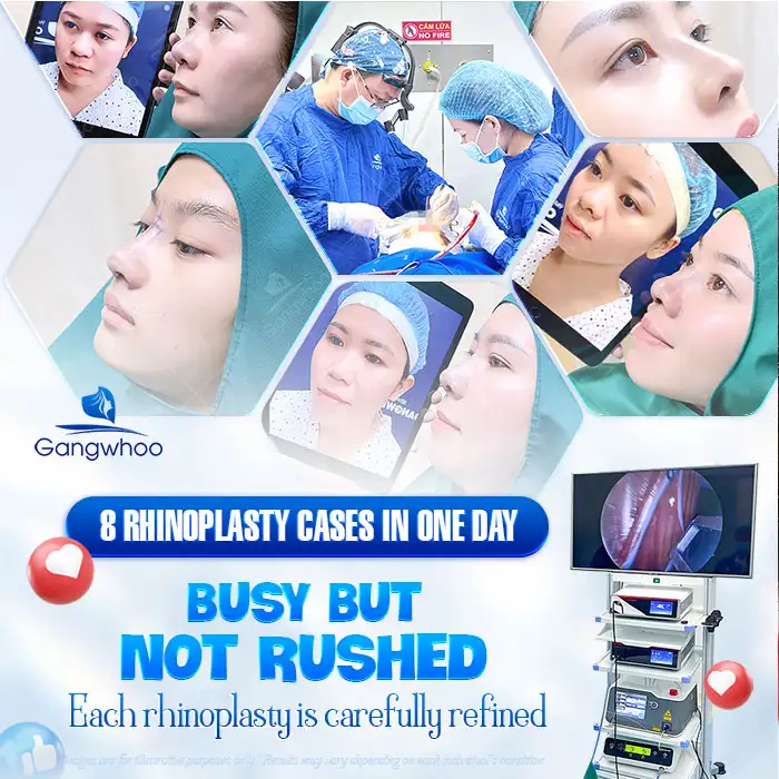 How Long After Rhinoplasty Can Implant Displacement Occur? How to Prevent Implant Displacement After Rhinoplasty