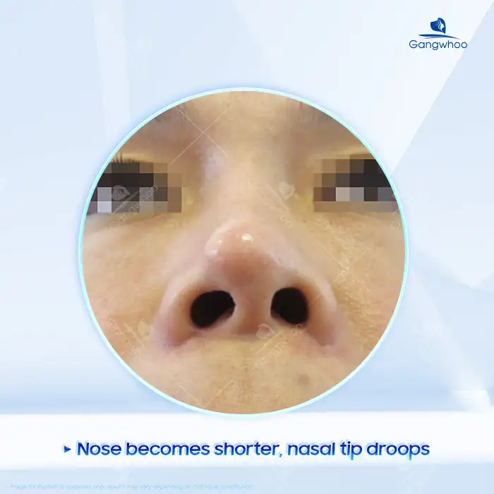 How Long After Rhinoplasty Can Implant Displacement Occur? How to Prevent Implant Displacement After Rhinoplasty