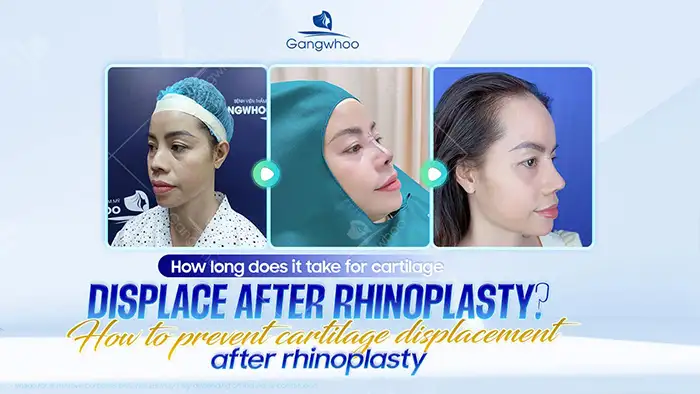 How Long After Rhinoplasty Can Implant Displacement Occur? How to Prevent Implant Displacement After Rhinoplasty