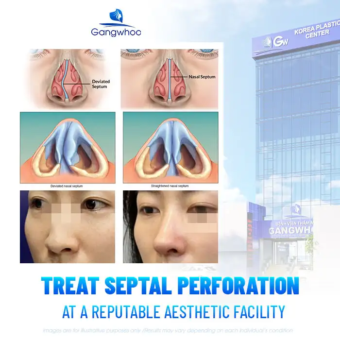 What are the causes of septal perforation after rhinoplasty? How is it managed?