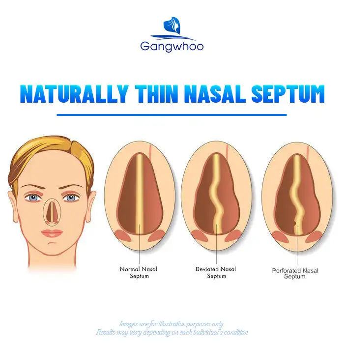 What are the causes of septal perforation after rhinoplasty? How is it managed?