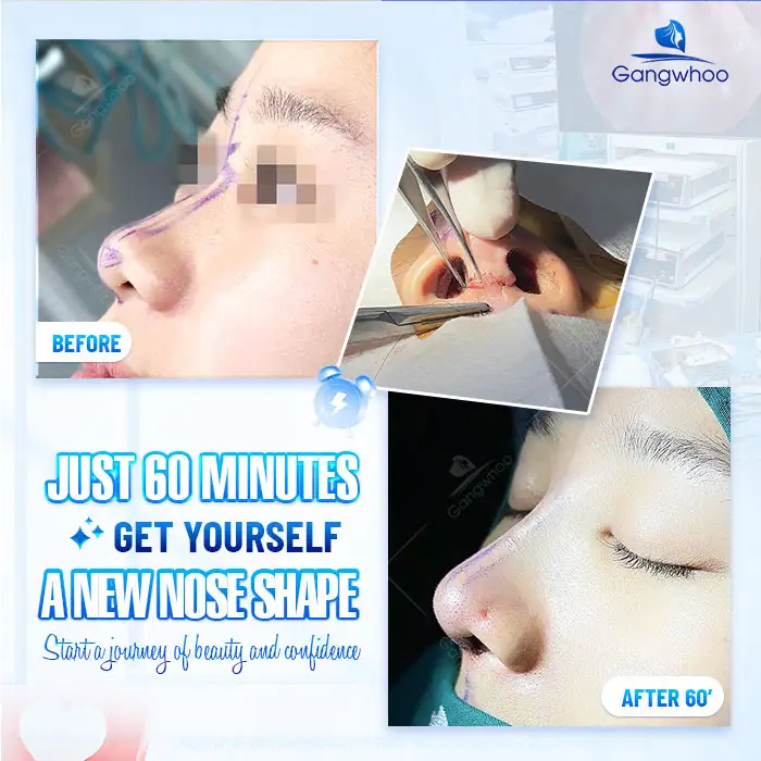 What is 4D ultrasound structural rhinoplasty? What are its advantages?