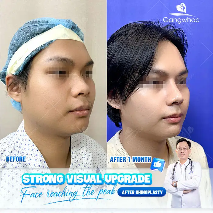 What is 4D ultrasound structural rhinoplasty? What are its advantages?