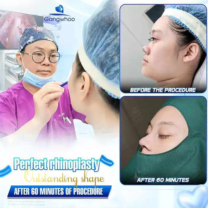 How long does it take for the nose to settle and become stable after structural rhinoplasty? How should it be cared for?