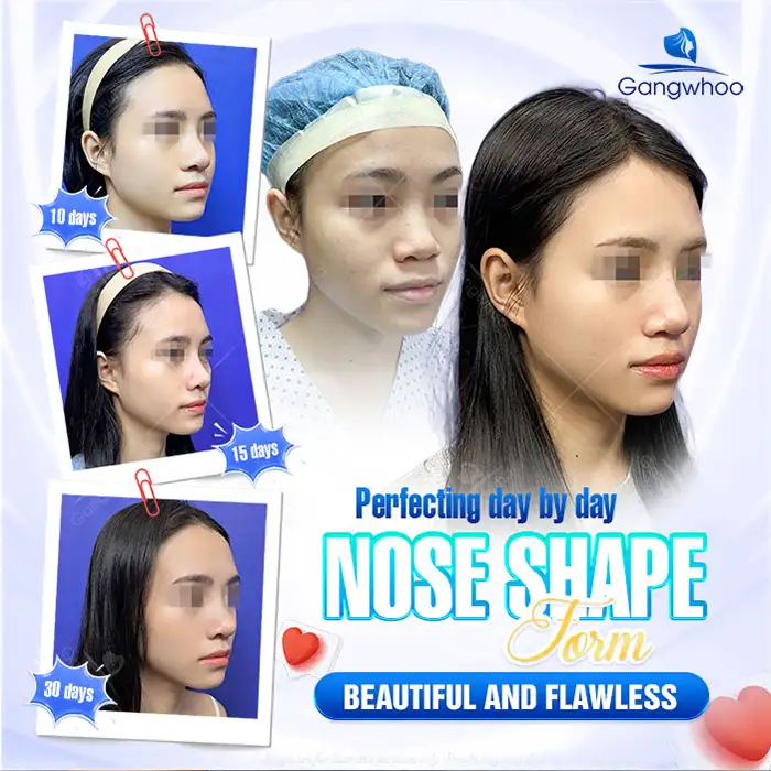 How long does it take for the nose to settle and become stable after structural rhinoplasty? How should it be cared for?