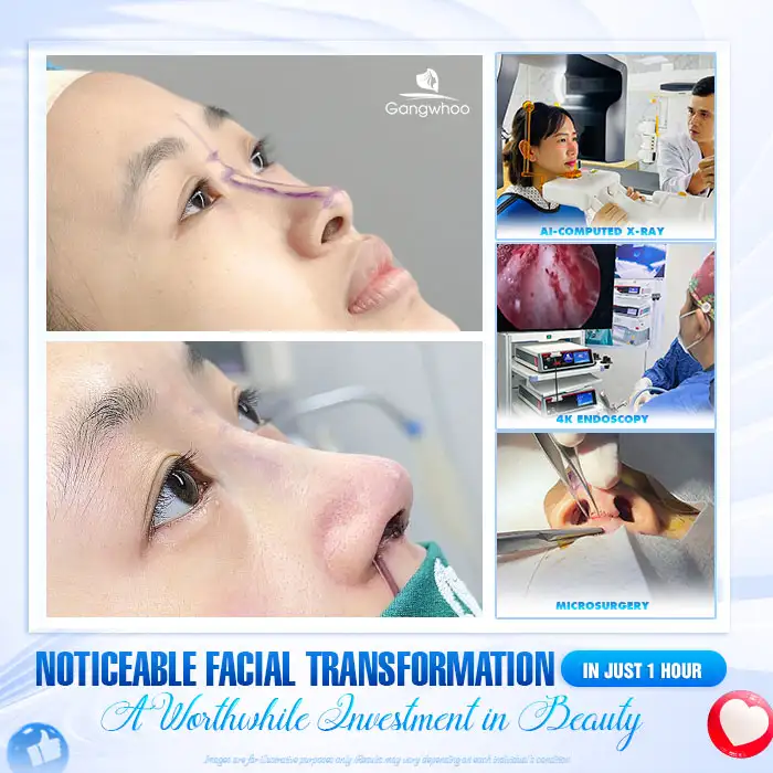 What are structural rhinoplasty and semi-structural rhinoplasty? Comparison between the two methods