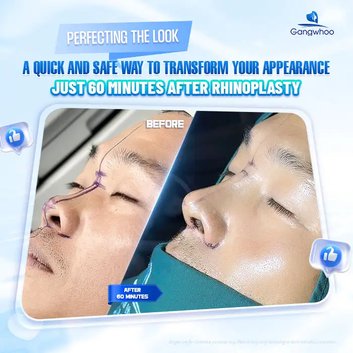 What are structural rhinoplasty and semi-structural rhinoplasty? Comparison between the two methods