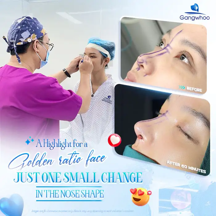 What are structural rhinoplasty and semi-structural rhinoplasty? Comparison between the two methods