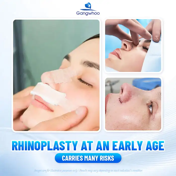 Rhinoplasty for children: Should it be done and what should be considered?