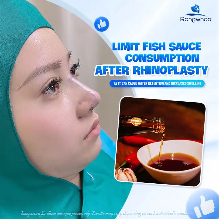 Is it okay to eat fish sauce after rhinoplasty? Does it cause any negative effects?