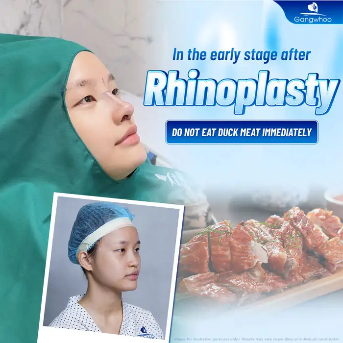 Can you eat duck meat after rhinoplasty? Is it necessary to avoid it?