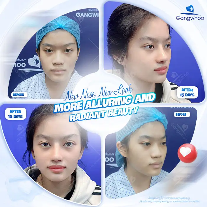 Is rhinoplasty covered by a warranty? What are the conditions for warranty coverage?