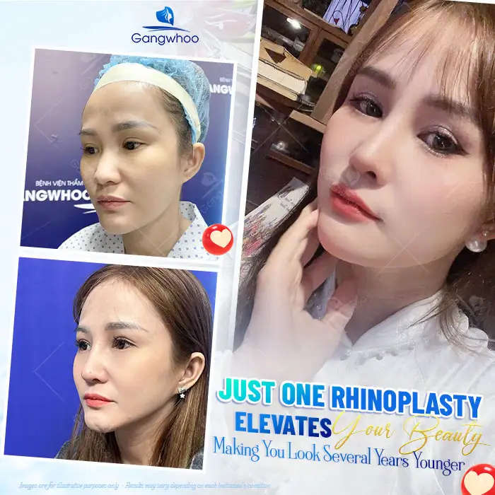 Is rhinoplasty covered by a warranty? What are the conditions for warranty coverage?