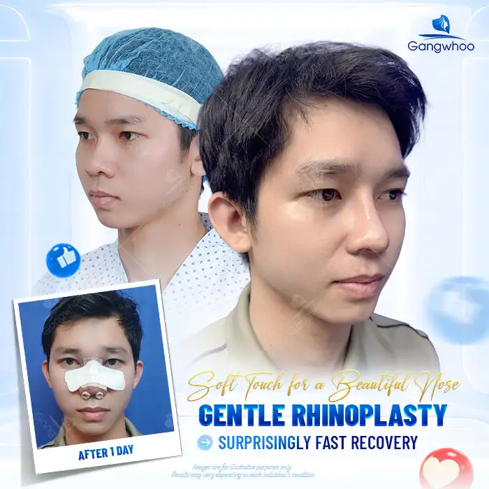 Is rhinoplasty covered by a warranty? What are the conditions for warranty coverage?