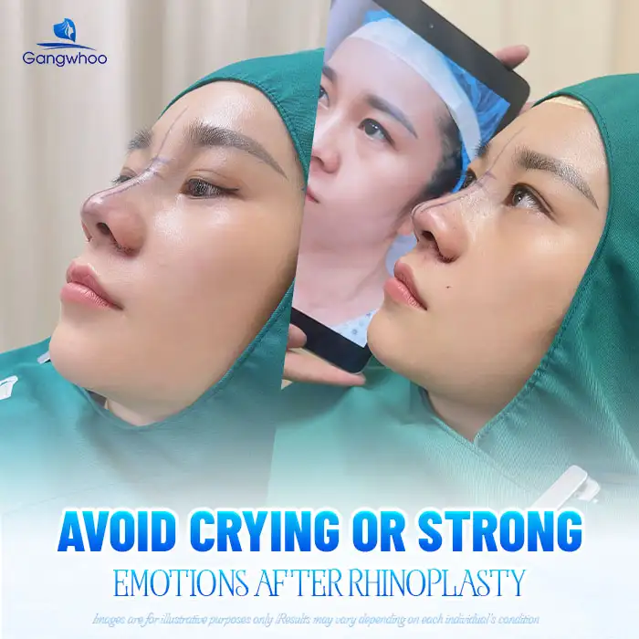 Is it okay to cry after rhinoplasty? Does it affect the nose after surgery? 1 Is it okay to cry after rhinoplasty? Does it affect the nose after surgery?