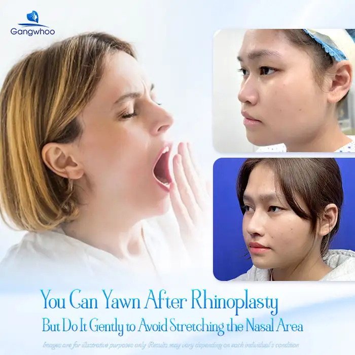 Can you yawn after rhinoplasty? Will it affect the nasal shape?