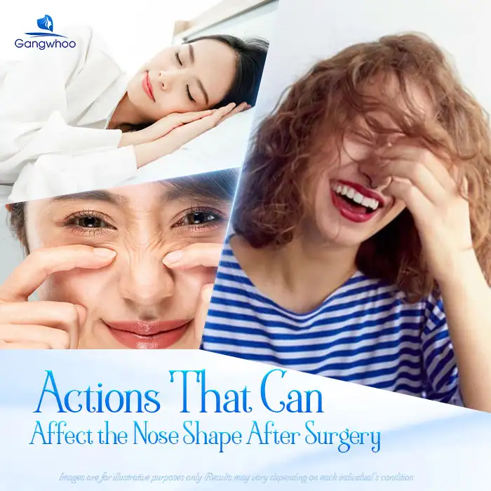 Can you yawn after rhinoplasty? Will it affect the nasal shape?