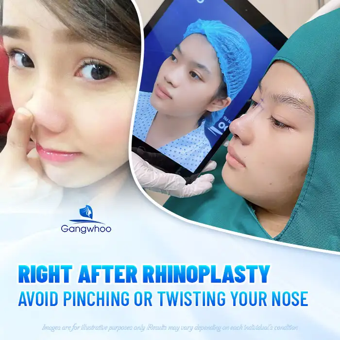 Can you pinch your nose after rhinoplasty? How long before you can twist or manipulate your nose?