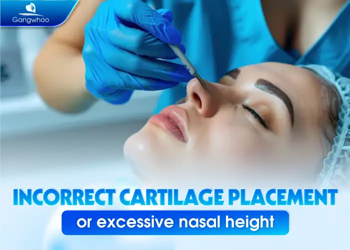 Why Does the Nasal Tip Become Pointed After Rhinoplasty? Causes and How to Manage It 2 Lưu nháp tự động