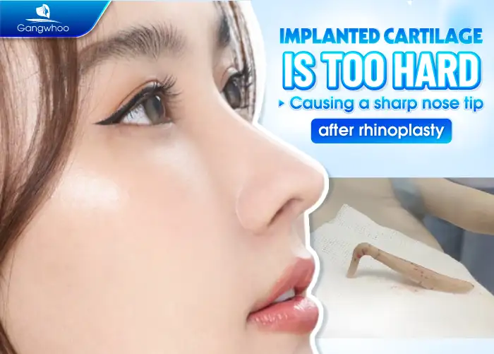Why Does the Nasal Tip Become Pointed After Rhinoplasty? Causes and How to Manage It 1 Lưu nháp tự động