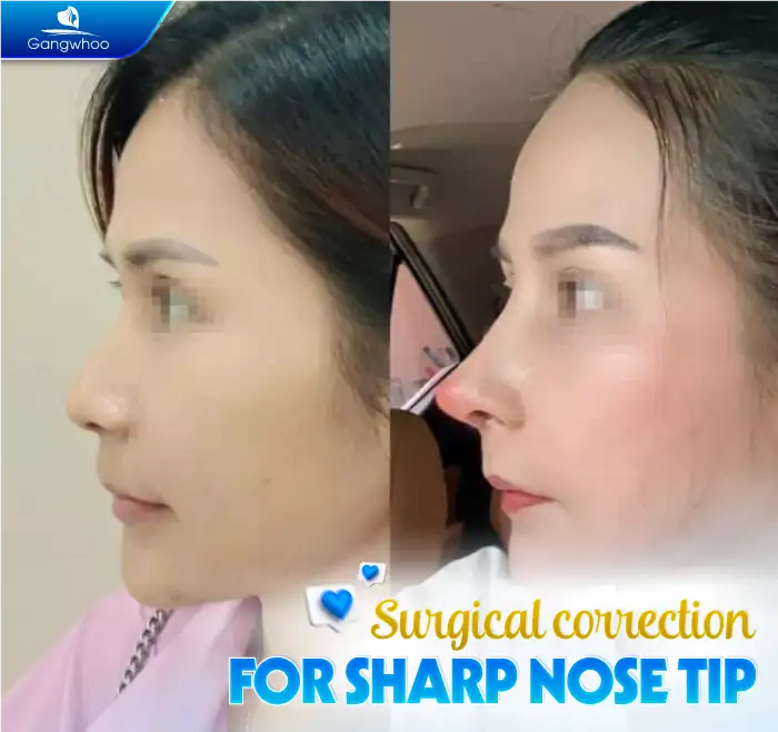 Why Does the Nasal Tip Become Pointed After Rhinoplasty? Causes and How to Manage It 3 Lưu nháp tự động