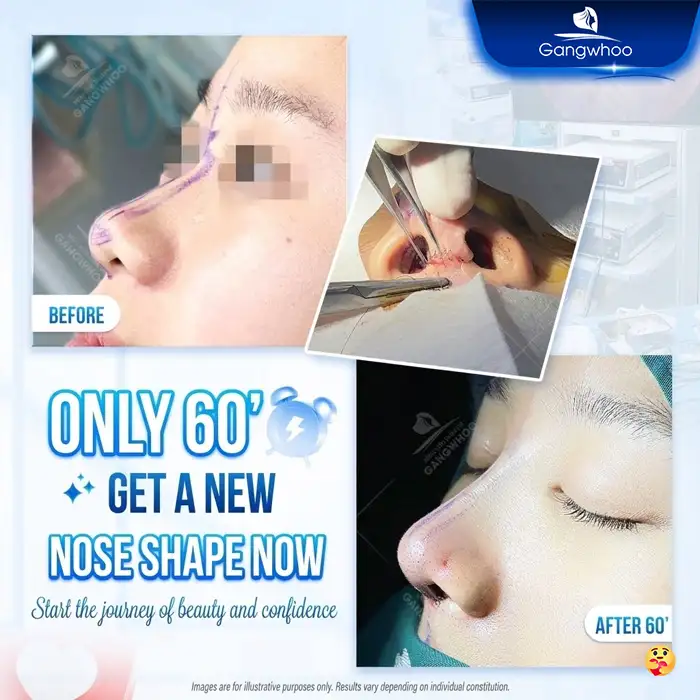 Why Does the Nasal Tip Become Pointed After Rhinoplasty? Causes and How to Manage It 4 Lưu nháp tự động