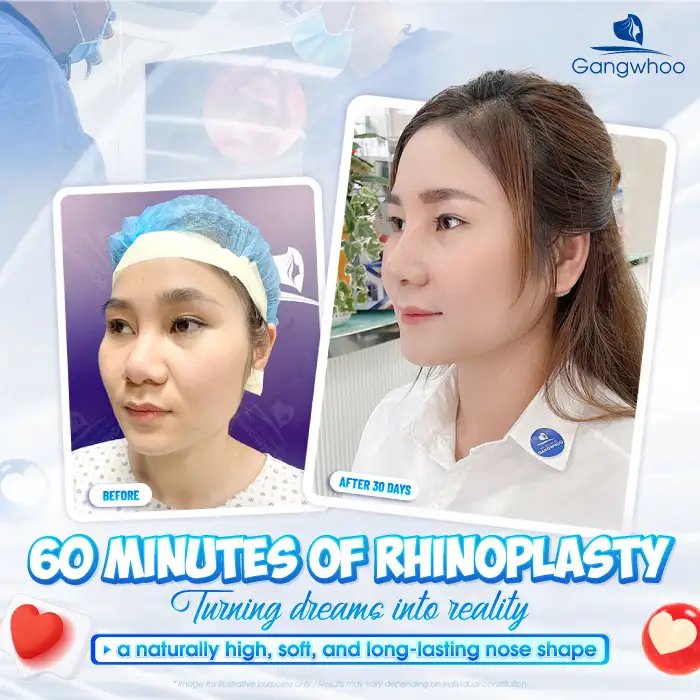 How much does Korean rhinoplasty cost? Updated latest price list for 2026