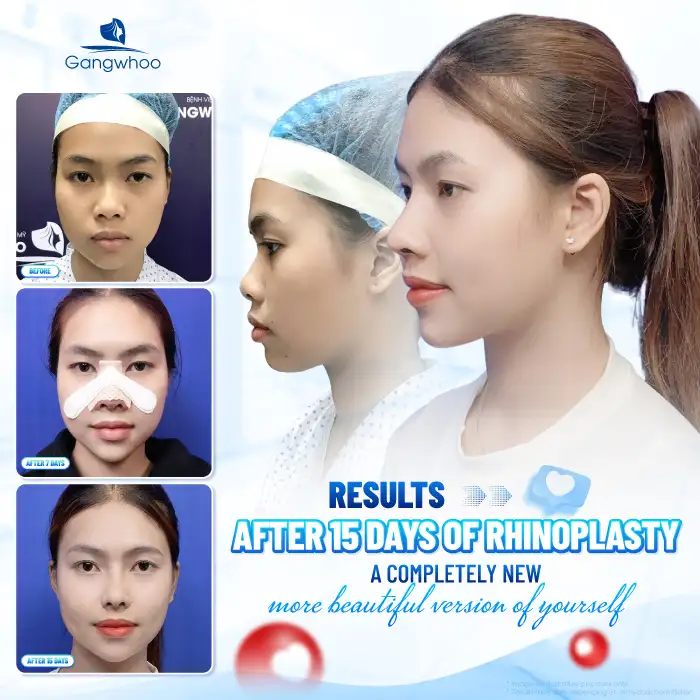 How many days after rhinoplasty can the nasal splint be removed? Can it be removed early?