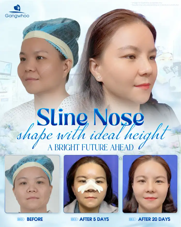 How many days after rhinoplasty can the nasal splint be removed? Can it be removed early?