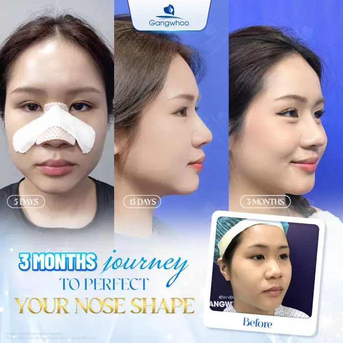 How many days after rhinoplasty can the nasal splint be removed? Can it be removed early?