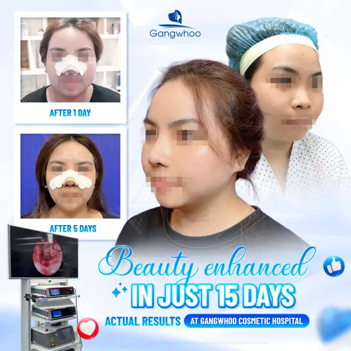 What is ultra-structural rhinoplasty? Advantages and disadvantages of this rhinoplasty method