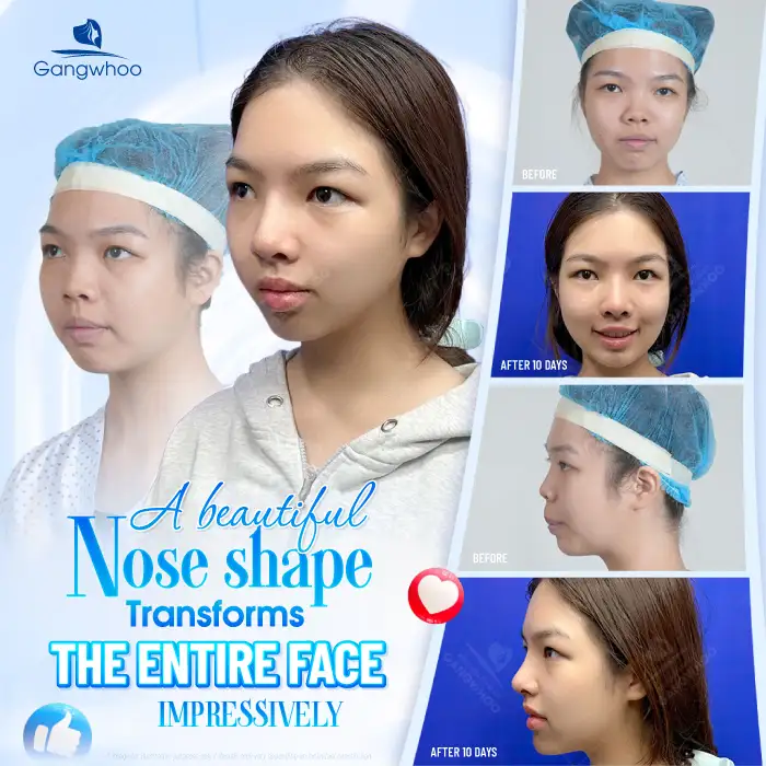 What is ultra-structural rhinoplasty? Advantages and disadvantages of this rhinoplasty method