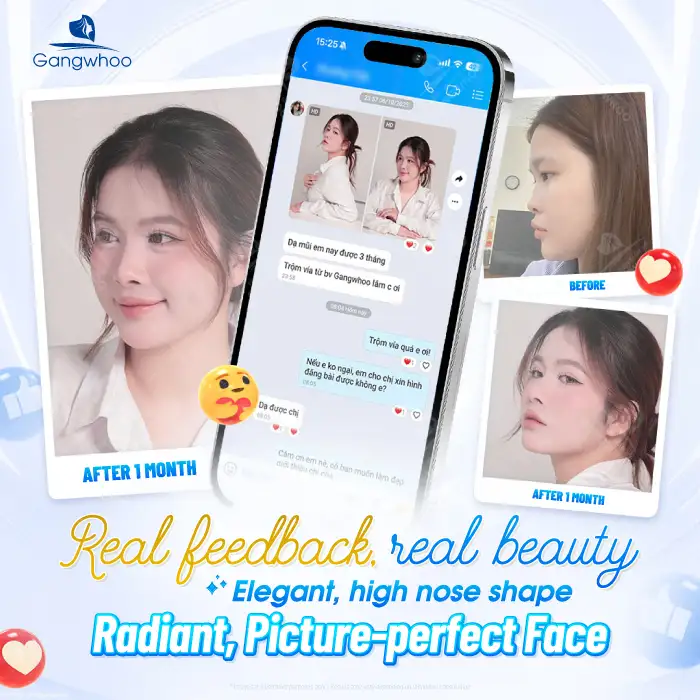 What is ultra-structural rhinoplasty? Advantages and disadvantages of this rhinoplasty method