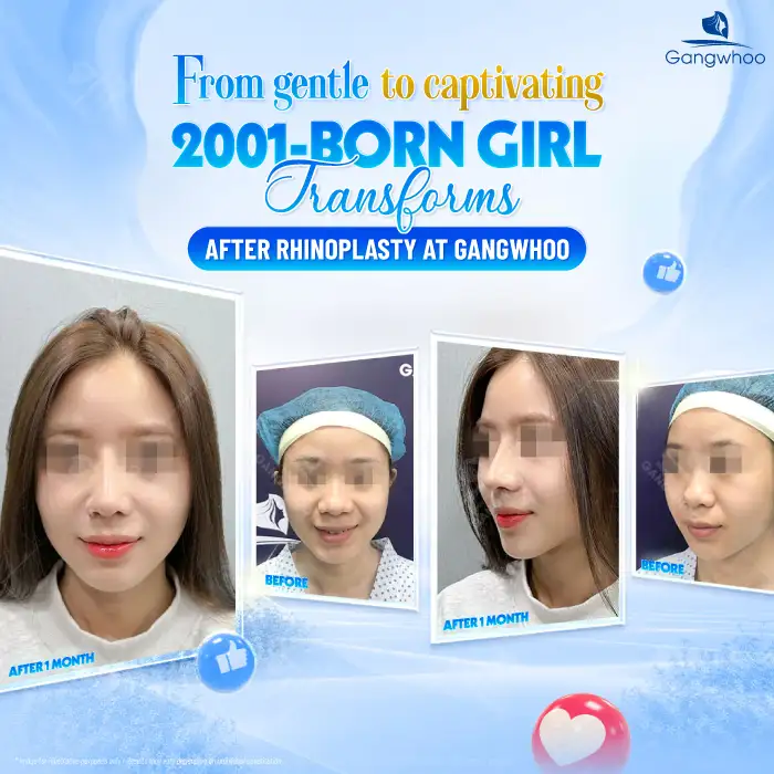 How long does silicone rhinoplasty last? Is it permanent?