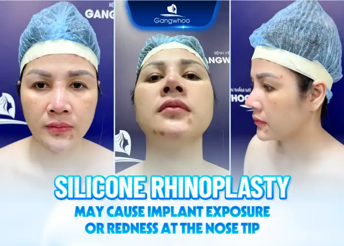 How long does silicone rhinoplasty last? Is it permanent?