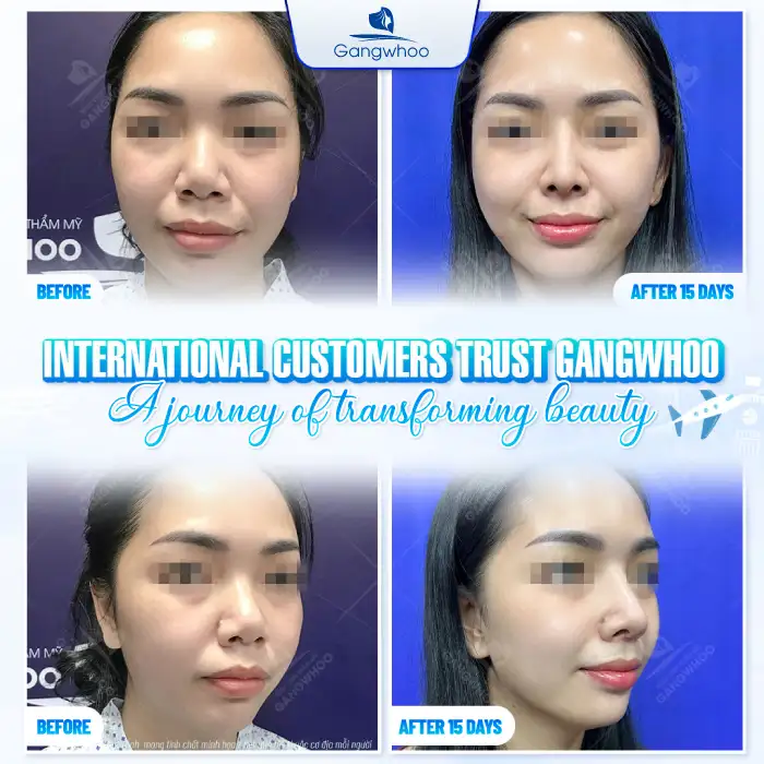 Is American cartilage rhinoplasty good? Should you choose it for rhinoplasty?