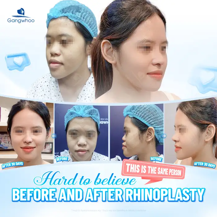 Is American cartilage rhinoplasty good? Should you choose it for rhinoplasty?