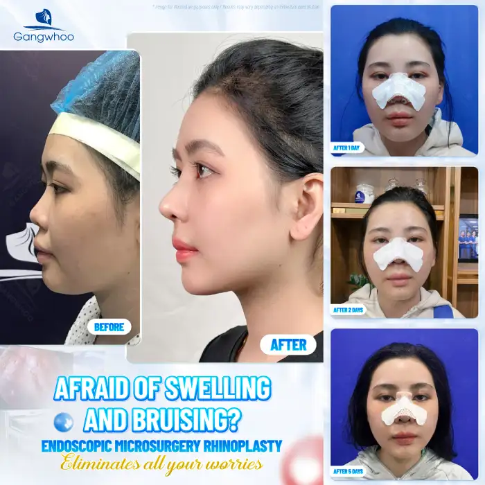 Is American cartilage rhinoplasty good? Should you choose it for rhinoplasty?