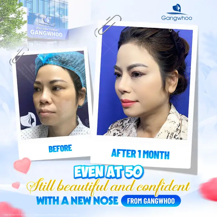 Is American cartilage rhinoplasty good? Should you choose it for rhinoplasty?