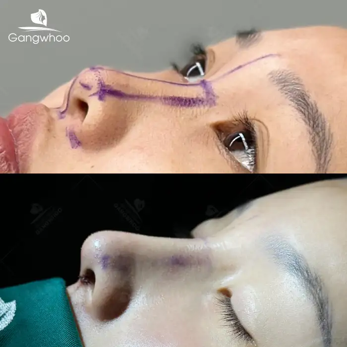 Is Synthetic Cartilage Rhinoplasty Permanent? Long-Term Maintenance Care