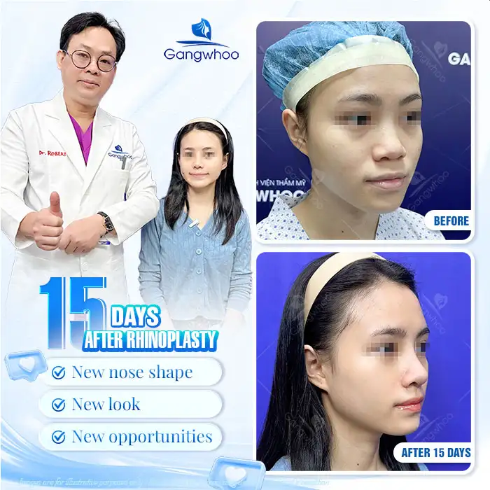 What Is Structural Rhinoplasty? When Should It Be Performed?