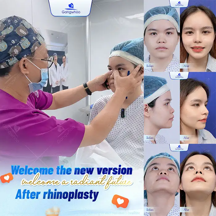 What Is Structural Rhinoplasty? When Should It Be Performed?