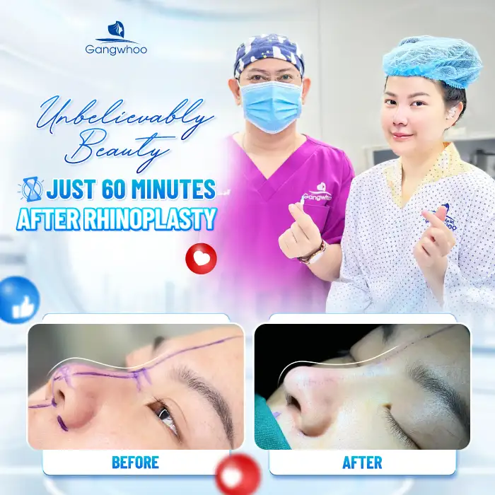 Comparison between conventional rhinoplasty and structural rhinoplasty: What are the differences?