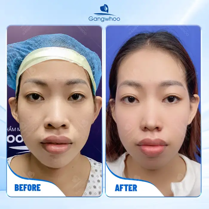 Comparison between conventional rhinoplasty and structural rhinoplasty: What are the differences?