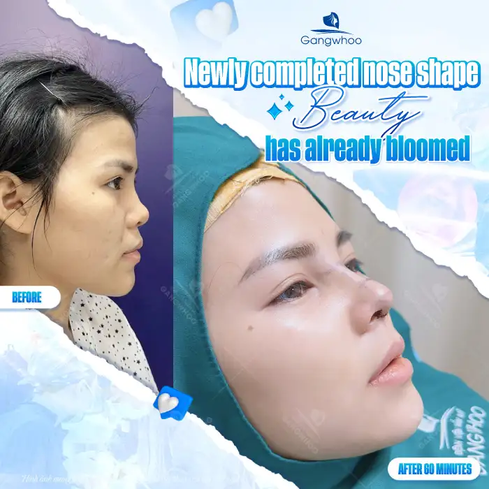 Comparison between conventional rhinoplasty and structural rhinoplasty: What are the differences?